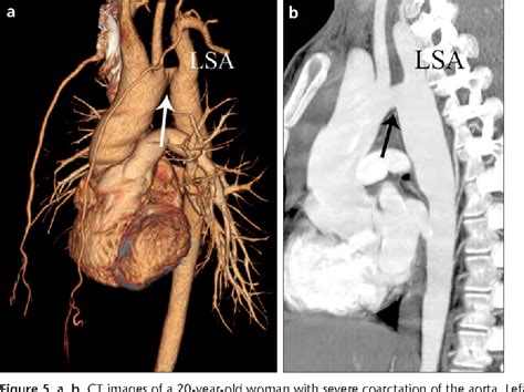 Figure 5 From Coarctation Of The Aorta In Adults Preoperative