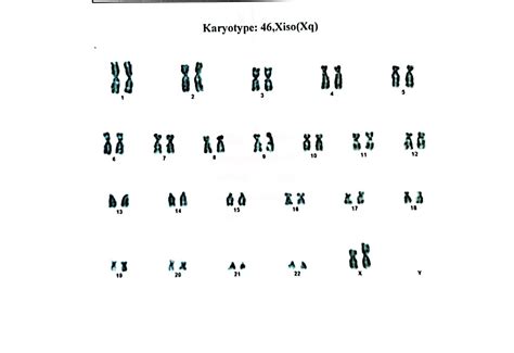 Cureus Turner Syndrome With Isochromosome Structural Abnormalities A