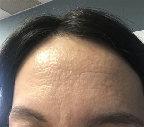 Texture On Forehead General Acne Discussion Forum