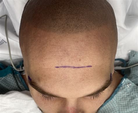 Male Mid Forehead Brow Bone Reduction Top View 1 Dr Barry Eppley