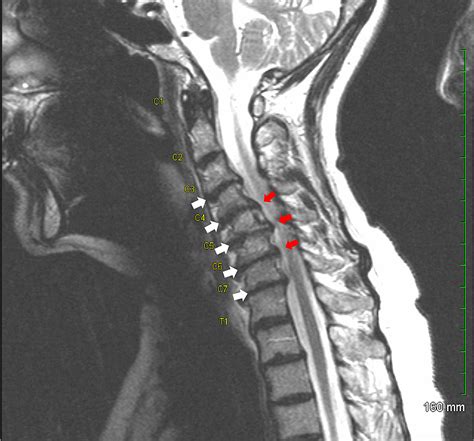 Cureus Five Level Anterior Cervical Discectomy And Fusion
