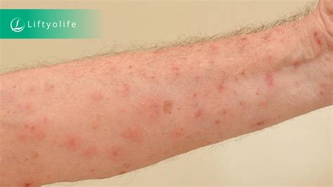 Contagious Skin Diseases Symptoms Treatment Liftyolife