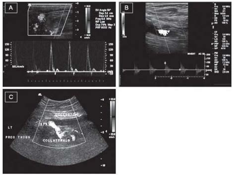 Role Of Vascular Ultrasonography In Peripheral Artery Disease