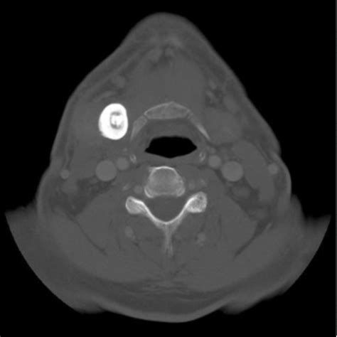 A Ct Scan Of The Neck With Contrast Demonstrating A Large Sialolith Of