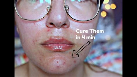 How To Treat Hormonal Acne White Bumps On Your Chin Youtube