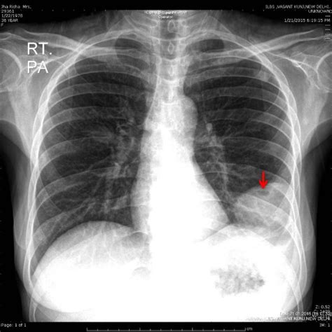 It allows distinction between free and loculated fluid showing its extent and localization. X-ray chest showing pleural based well defined, homogenous opacity with... | Download Scientific ...