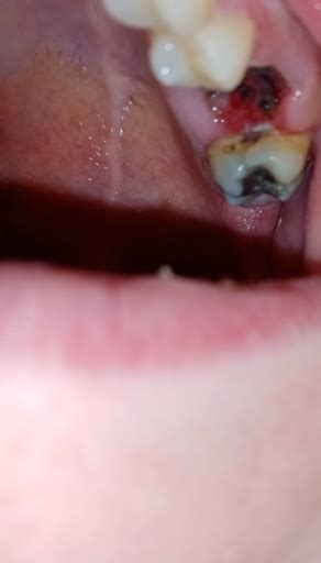 Wisdom Tooth Removal For Pericoronitis