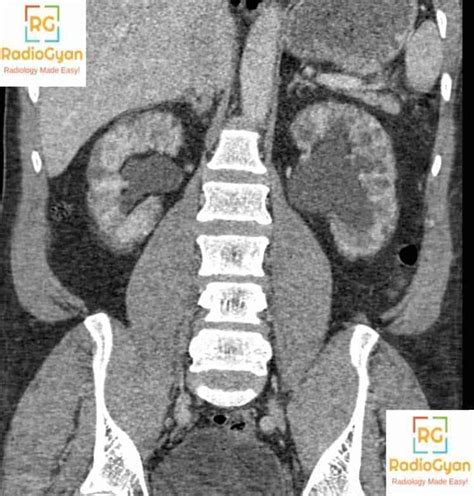 Lithium Nephropathy Radiology Reference Article Cases Radiogyan