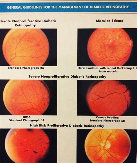 Diabetic Retinopathy Stages Diabetic Retinopathy Eye Care Health