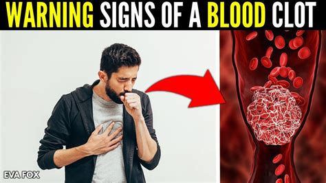 Warning Signs Of A Blood Clot That You Should Never Ignore Youtube