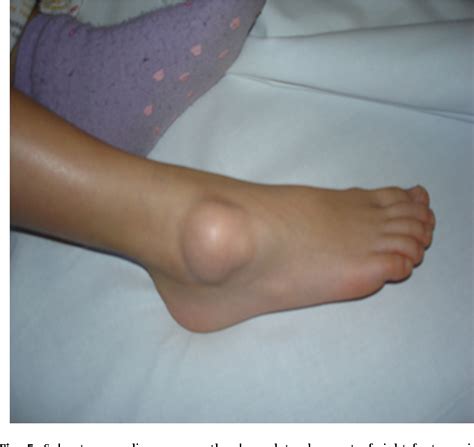 Figure 5 From Tumours Of The Foot And Ankle Semantic Scholar