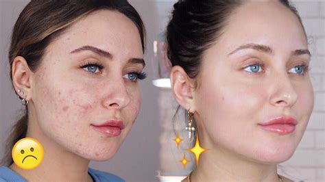 How To Get Rid Of Acne Scars Sunvamet