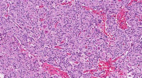 Well Differentiated Neuroendocrine Tumour Of The Pancreas