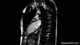 Cardiac MRI Scan Heart Beat In Real Time HD On Make A GIF
