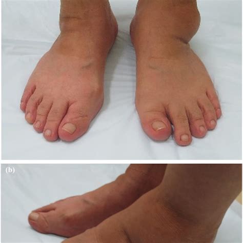 Photographs Showing Cystic Swelling Anterior To The Lateral Malleolus