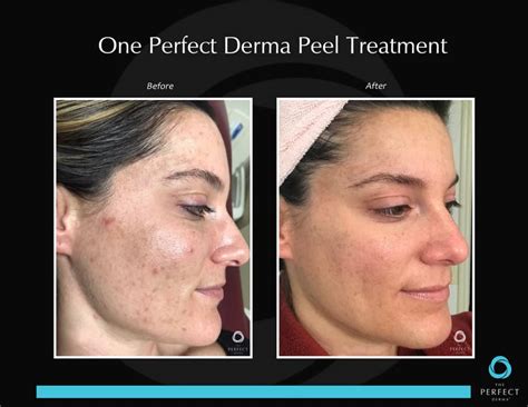 Perfect Derma Peel Beauty And Body Med Lounge And Spa