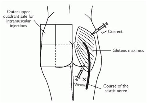 How To Give An Intramuscular Injection Intramuscular Injection Sites Images