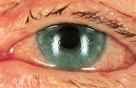 Study Medical Photos Acute Angle Closure Glaucoma