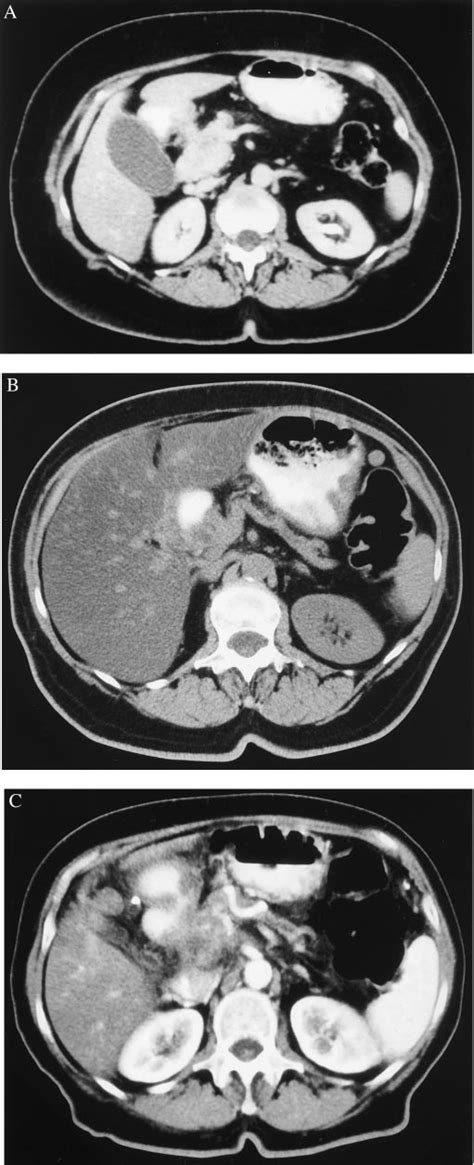 Ct Scans Of The Patient With Pancreatic Head Cancer Before A And 1