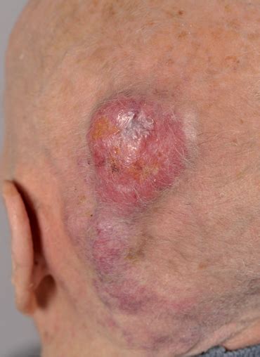 Post Transplant Merkel Cell Carcinoma Html Acta Dermato Venereologica