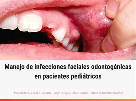 Pdf Caracter Sticas Y Manejo De Infecciones Faciales Odontog Nicas En Pacientes Pedi Tricos