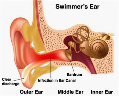 Otitis Externa Ear