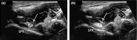 Sonographic ‘flash A Case Report Of A New Sign In Dynamic Ultrasound