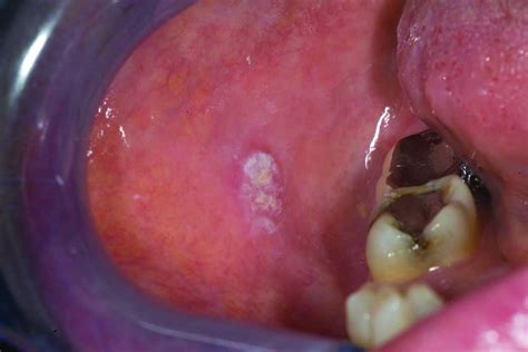 Squamous Cell Carcinoma Of The Oral Cavity In Nonsmoking Women A New And Unusual Complication