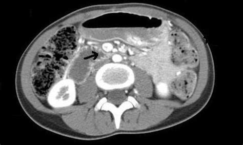 CT Scan Of The Abdomen And Pelvis With And Without Contrast