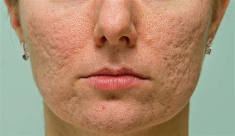 Special Feature Addressing Acne Scars With Lasers Aesthetics