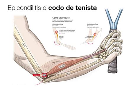 Epicondilitis Lateral Codo De Tenista Cirugía De Mano Valencia