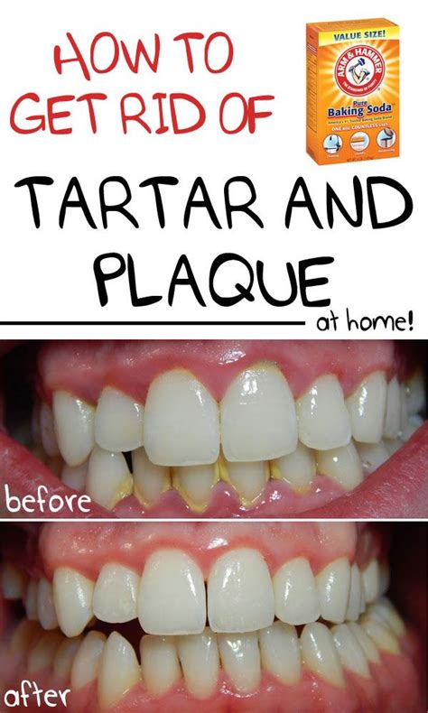 This is not always an easy question to answer since it sometimes this layer or layers gets to 3/8 to 1/2 in thickness, becoming as hard and black as a. Die besten 25+ How to get rid of plaque on teeth Ideen auf ...