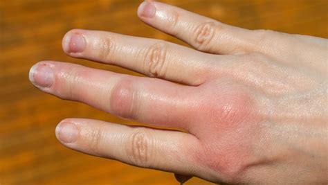Finger Swelling Treatment In Winter Urdu Totkay