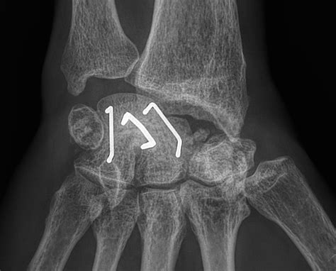 Arthrose du poignet Clinique Ostéo Articulaire des Cèdres Grenoble