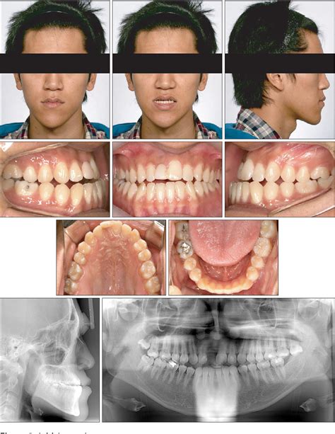 Figure 3 From New Bimaxillary Orthognathic Surgery Planning And Model