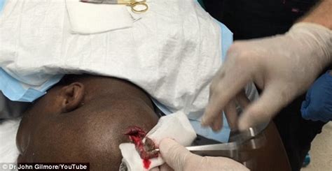 Medically, hair loss falls into several. Patient has a cyst the size of a golf ball removed from ...
