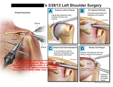 Same as for infraspinatus and inferior to this for the more inferior part of the posterior labrum. AMICUS Illustration of amicus,surgery,shoulder,portal ...
