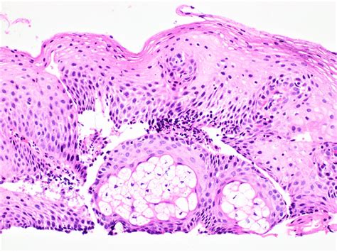 Pathology Outlines Heterotopic Ectopic Sebaceous Glands