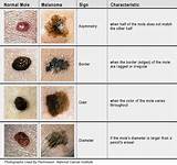 Pictures of What Doctor To See For Moles