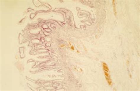 Low Power Photomicrograph Of Mucosal Biopsy Specimen Twin Stained