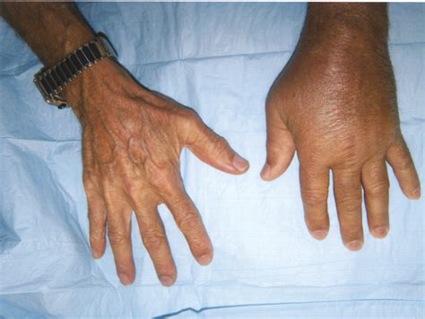 Pictures Of Gout In Hand And Wrist Picturemeta