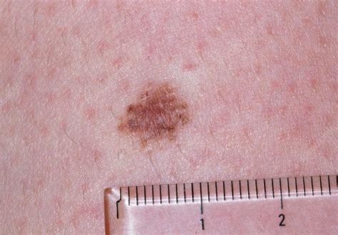 Intradermal Naevus On Human Skin Stock Image M2200043 Science