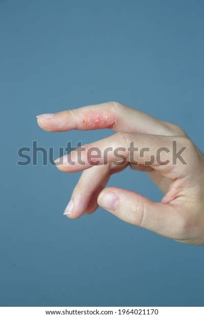 Atopic Hand Dermatitis Eczema On Fingers Stock Photo 1964021170