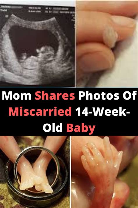 Mom Shares Heartbreaking Photos Of Miscarried 14 Week Old Fetus To
