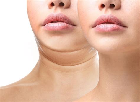Double Chins Have Met Their Match With Kybella Alpha Internal Medicine