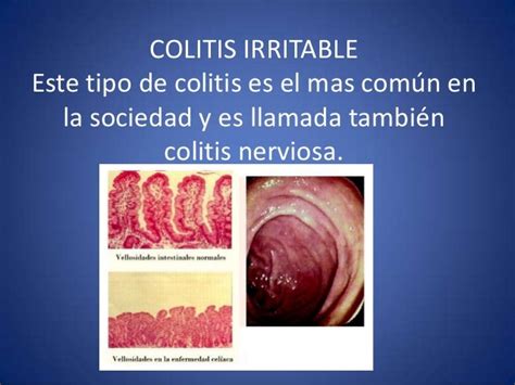 Colitis Y Su Clasificacion