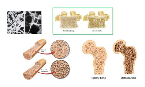 Understanding Bone Density Tests Can Help Prevent Further Problems