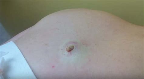 Cyst On The Back Incision And Drainage New Pimple Popping Videos