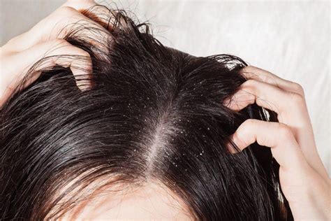 Swędzenie skóry głowy przyczyny objawy i leczenie