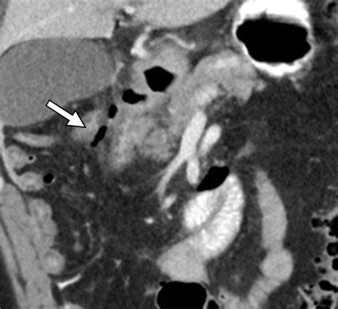 Imaging Spectrum Of Duodenal Emergencies Radiographics